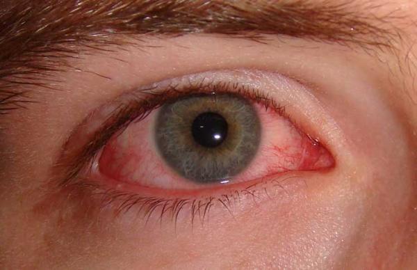 10 درمان خانگی برای رفع کردن التهابات آلرژیک چشم