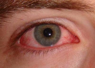 10 درمان خانگی برای رفع کردن التهابات آلرژیک چشم