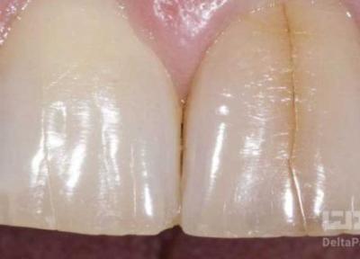 دلیل ترک خوردن دندان چیست؟ چگونه درمان می گردد؟